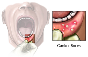 canker