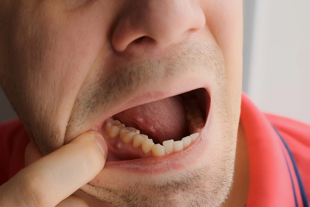 Man with an abscess on his gums examines his mouth.