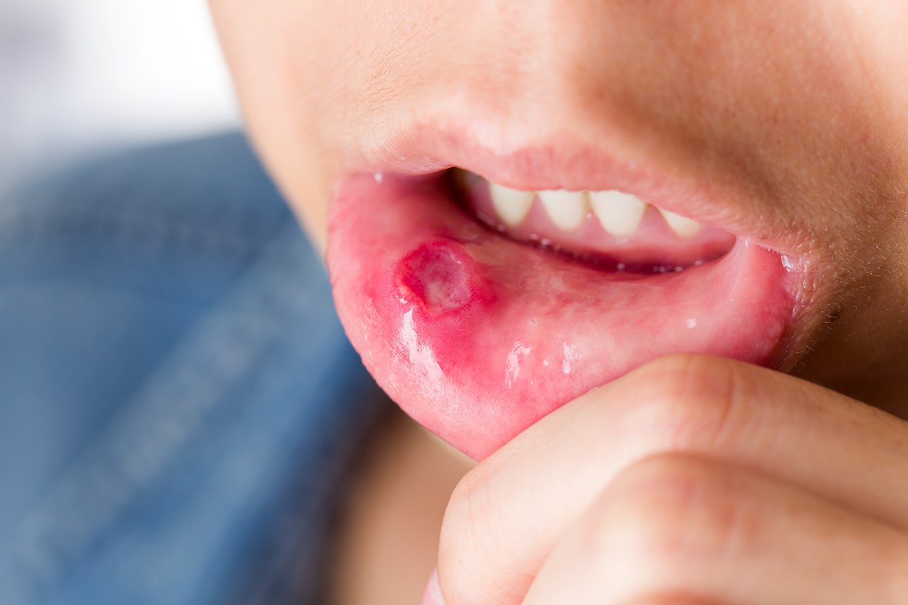 Woman with a canker sore on her lower lip. 